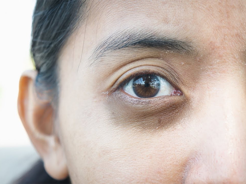 dark circles under eyes causes